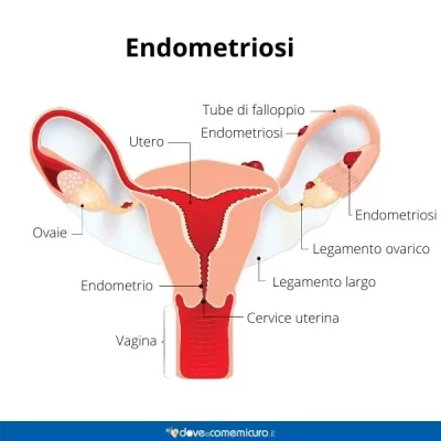 Endometriosi: invasione di endometrio (rivestimento dell’utero)